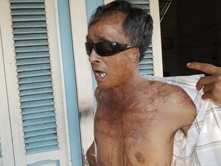 Sau cơn ghen độc ác của người tình, Sáu trở thành kẻ tàn phế suốt đời.
